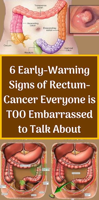 6 Early Warning Signs Of Rectum Cancer Everyone Is Too Embarrassed To