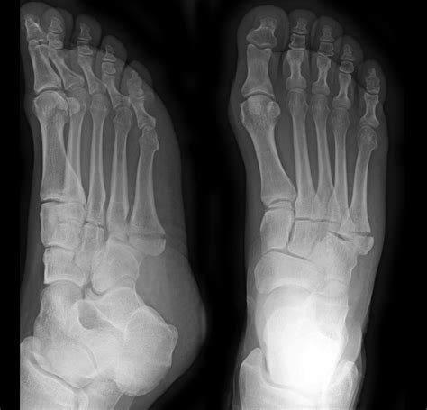 Jones Fracture Image