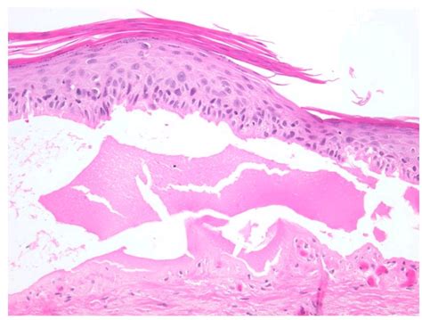 Epidermis Shows Hyperkeratosis Parakeratosis And Dysplasia Of