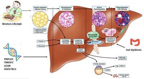 Figure Pathogenies Of Nafld Adapted From Cusi K Endotext