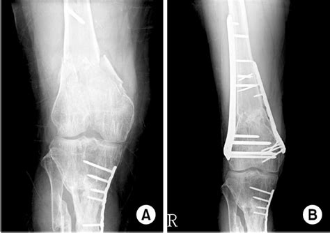 A Ao Ota Classification Type C 2 Distal Femur Fracture B Medial Download Scientific