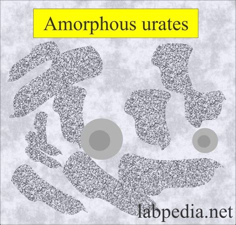 Urine Crystals (Crystalluria) - Labpedia.net