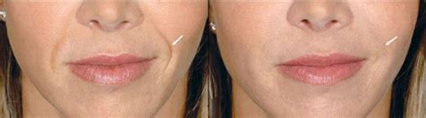 Dermal Fillers Restylane Juvederm Radiesse Artefill In