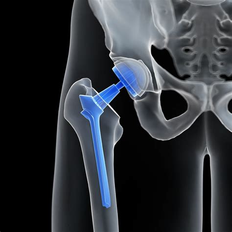 Hip Replacement Surgery • Dr. Paul Miano