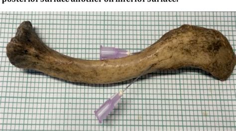 Morphometric Topographic Study Of Nutrient Foramen In Human Clavicle