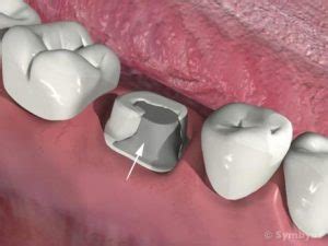 Dental Crown Core Buildup, What is it?, Costa Rica Dental Team Dentists