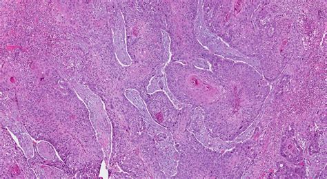 HPV-independent squamous cell carcinoma of the oropharynx | Ottawa ...