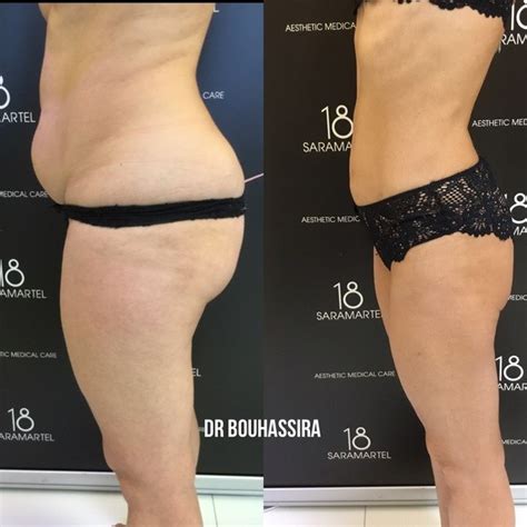 Liposuccion Dr Bouhassira Sp Cialiste Cannes Antibes De La Liposuccion