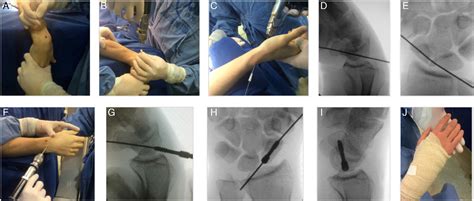 Scielo Brasil Percutaneous Treatment For Waist And Proximal Pole