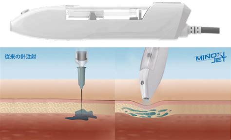 Agaスキンクリニックのミノキジェットは「傷and痛みなし」の新しいメソセラピー！drsメソとの違いも解説 Aga治療体験談