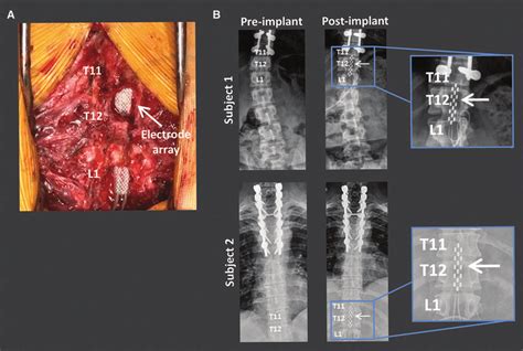 Surgical Implantation Of The Ees Electrode Array Spanning The Download Scientific Diagram