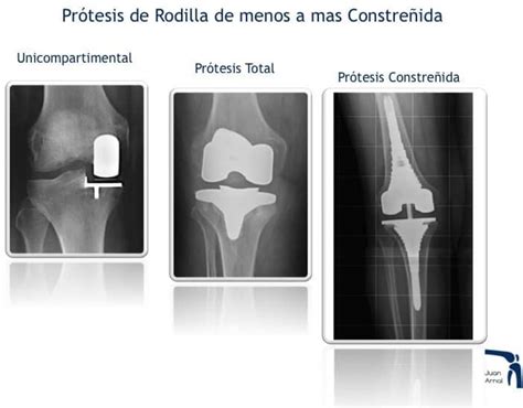 Pr Tesis De Rodilla Juan Arnal Traumatologo En Madrid