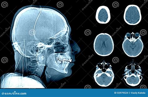 Normal Head On Ct Scans Stock Photo Image 55979524