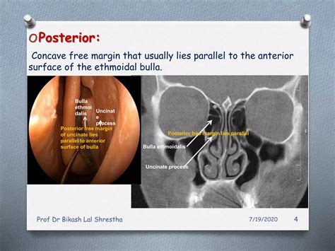 All about uncinate process of nose and paranasal sinuses | PPT | Free ...