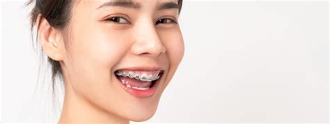 Premium Photo Face Of A Young Smiling Asian Woman With Braces On Teeth Orthodontic Treatment