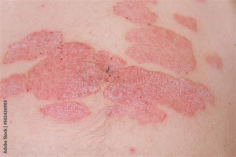 Large Red Inflamed Scaly Rash On The Stomach Acute Psoriasis On The