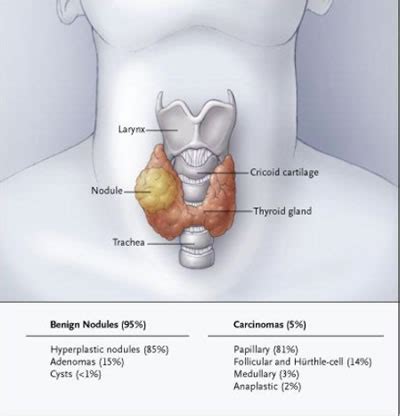 Thyroiditis: Thyroiditis Lump In Throat