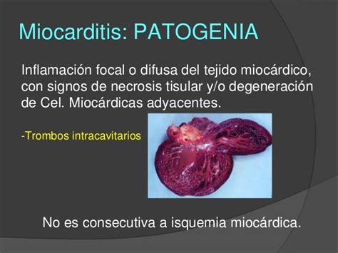 Miocarditis