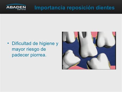 Importancia de la reposición de los dientes