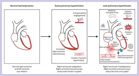 Pathophysiology And New Advances In Pulmonary Hypertension Bmj Medicine