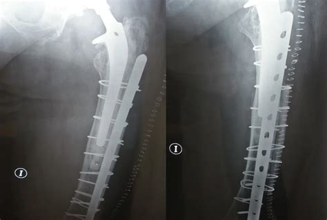 Fractura Periprotésica De Cadera