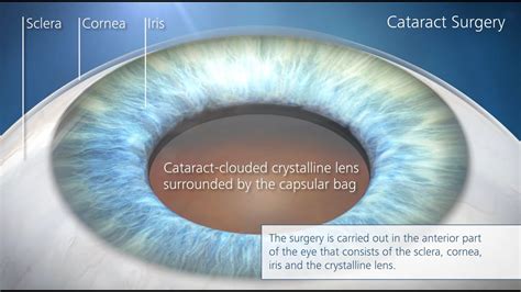 Cataract Surgery Procedure Step By S