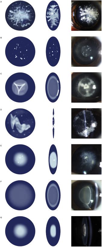 Early Diagnosis Of Syndromic Congenital Cataracts In A Large Cohort Of