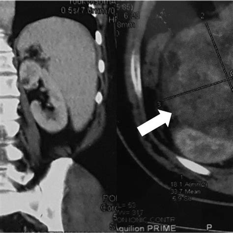 Multidetector Computed Tomography Of The Abdomen And Pelvis Sagittal