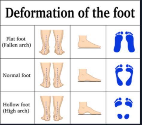 Opp Lab Posture Gait And Scoliosis Flashcards Quizlet