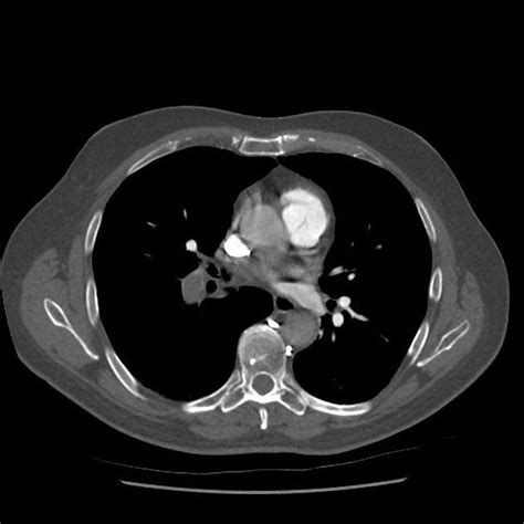 Brown Hospital Medicine On Twitter A Year Old Man Presented With