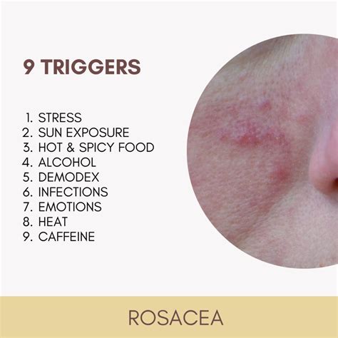 Rosacea Katu Dermatology Clinic