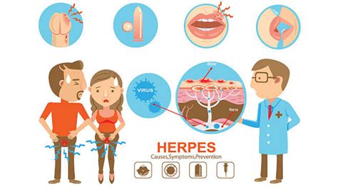 Gejala Dan Rawatan Virus Herpes Sisrasa