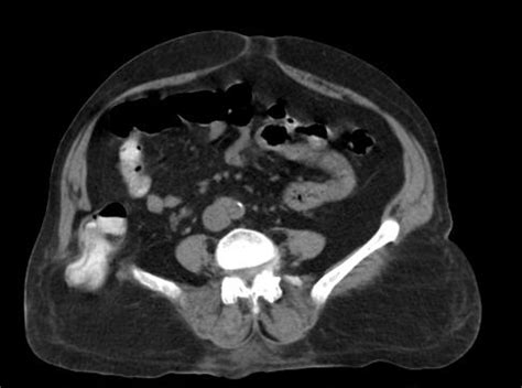 Radiopaedia Case Petit Hernia Id 33450 Study 34500 NC Commons