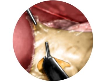 Laparoscopic Toupet fundoplication