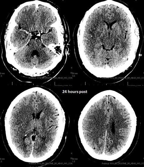 Case Archives Stroke CT vs CT Perfusion | neuroangio.org