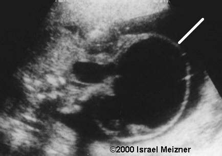 📃 Sacrococcygeal teratoma, Type I