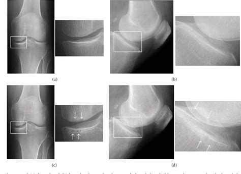 Figure 1 From A Case Of Spontaneous Osteonecrosis Of The Knee With Early And Simultaneous