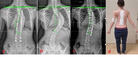 Figure 2 From Idiopathic Early Onset Scoliosis Treated With Magec Rods