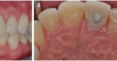 Implant Placement Decisions In Dentistry