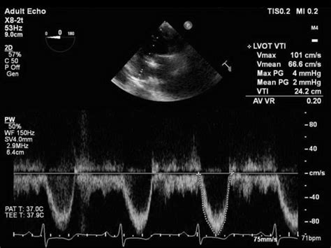 Echocardiography Tutorial Echocardiographic Modes