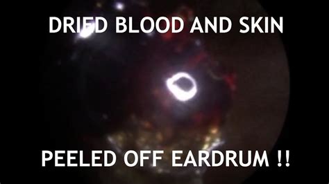 Crusted Dried Blood And Skin Peeled Directly Off Eardrum 442 Youtube