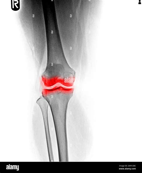 Osteoarthritis Knee Film X Ray Ap Anterior Posterior Stock Photo