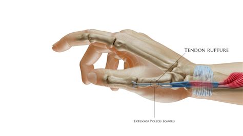 West Palm Beach Thumb Tendon Surgery Wellington Hand Tendon Injury Repair