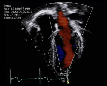 Echocardiogram (heart ultrasound)