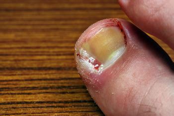 Border Podiatry Centre | Toenail Problems