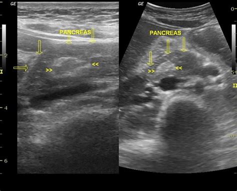 Radiology Quiz Radiopaedia Orgviewing Playlist Normal Variants