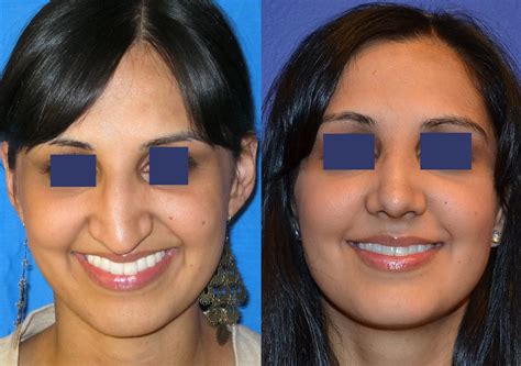 Cosmetic Rhinoplasty Ethnic Rhinoplasty Septoplasty