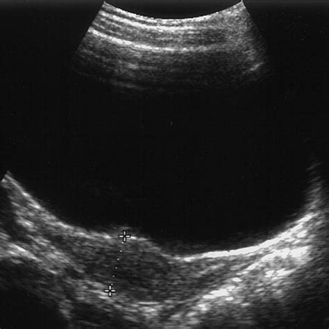 Diagnostic Accuracy Of Female Pelvic Ultrasonography In Differentiating