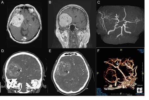 Figure From Coexistence Of Intracranial Solitary Fibrous Tumor