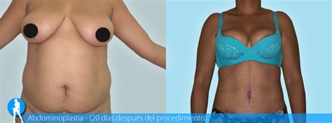 Abdominoplastia y Lipoescultura Antes y Después